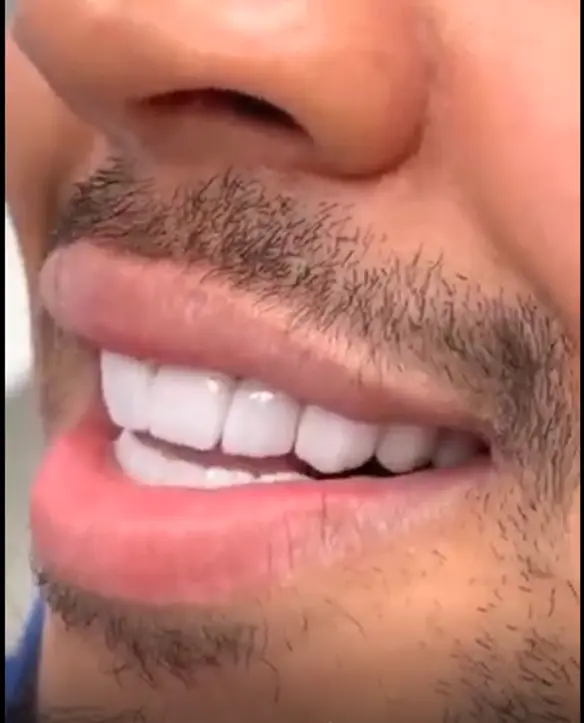 Faccette dentali