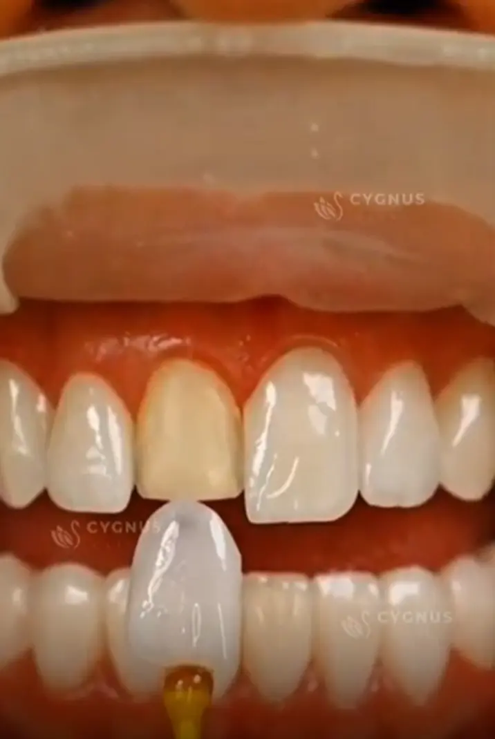 Design del Sorriso (Hollywood Smile) cygnus